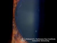 Pseudoexfoliation syndrome demonstrating the three identifiable zones on the anterior lens capsule. Note in the second picture (taken from a different patient) the white flaky material deposits on the pupillary margin.